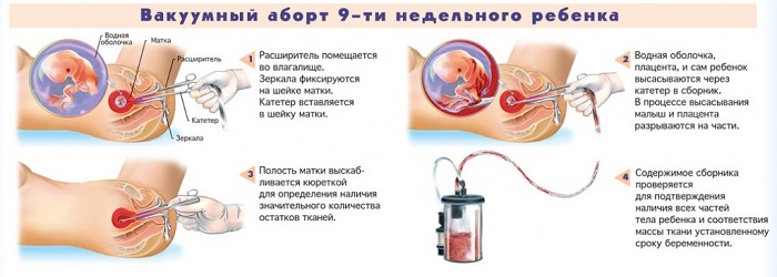 Хирургический аборт как метод прерывания беременности